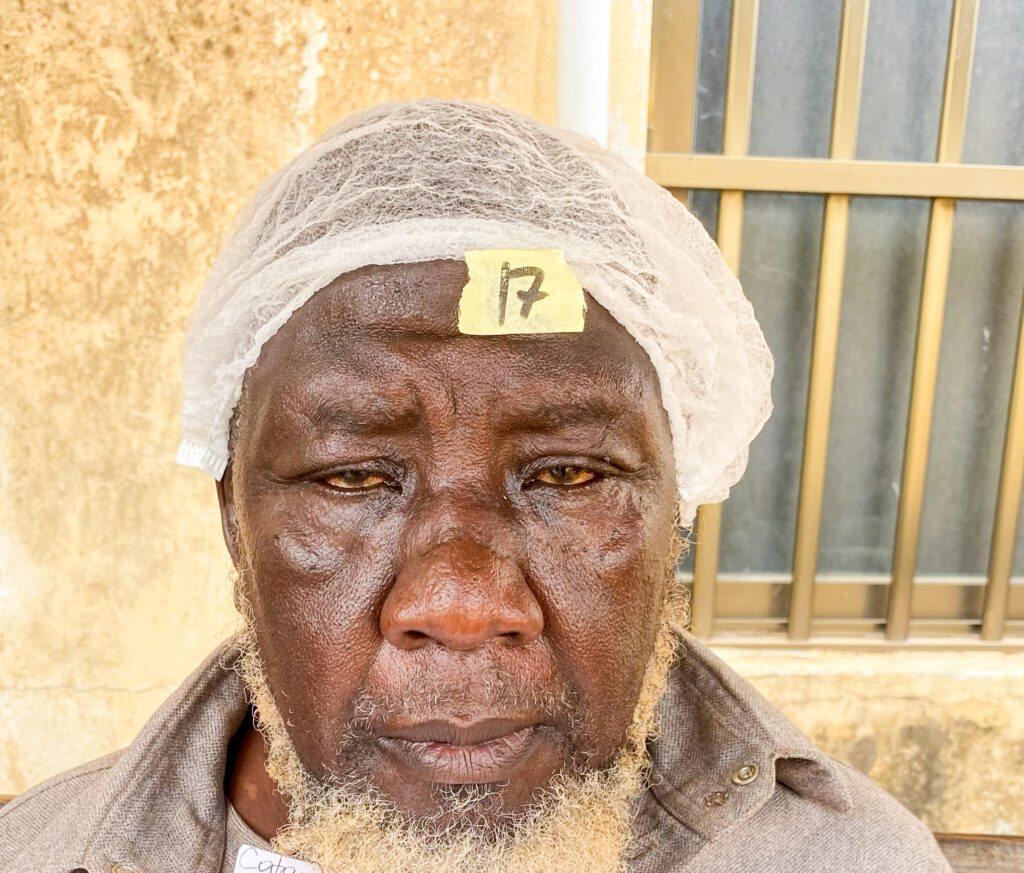 Moustapha before cataract surgery during a Sight.org outreach