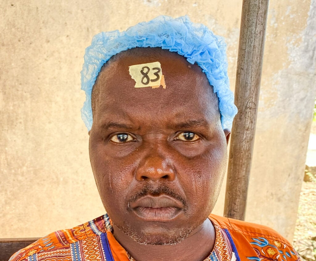 Kabafei Tchilabalo before cataract surgery during Sight.org outreach.